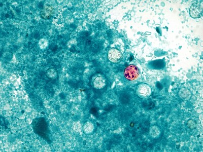 MINNEAPOLIMEDIA NEWS | Minnesota Families Urged to Watch for Cyclospora Symptoms as Nationwide Parasitic Illness Investigation Expands