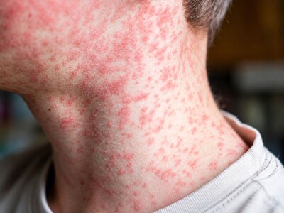 MINNEAPOLIMEDIA NEWS | Minnesota Measles Cases Reach 80 as Public Health Concerns Intensify